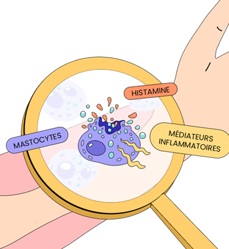 Maladies mastocytaires