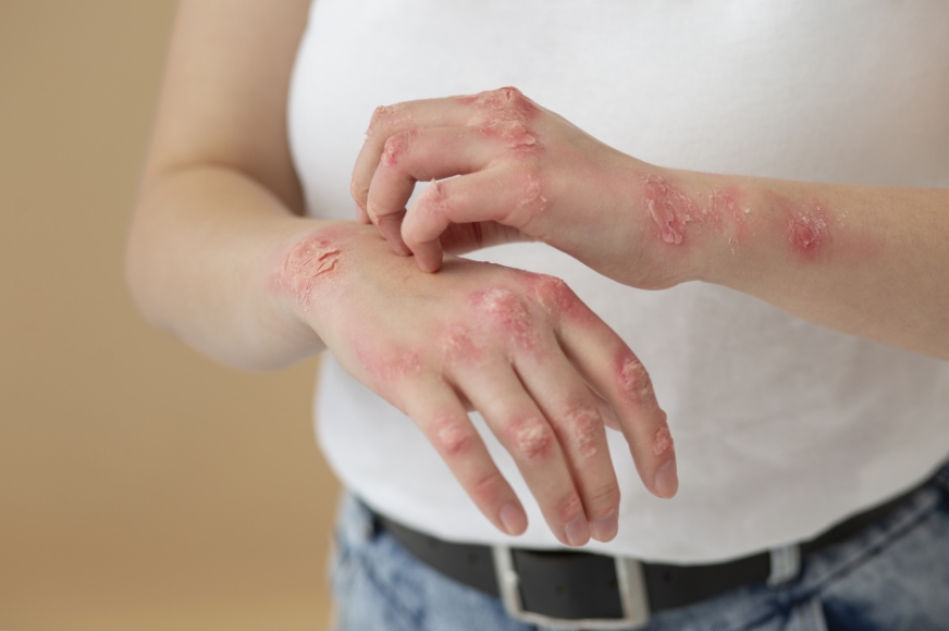 La dermatite atopique n'est pas une allergie